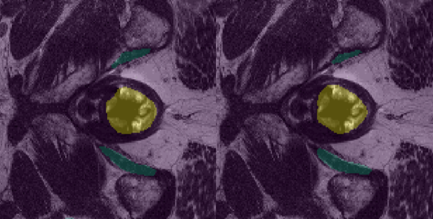 Pelvis MRI Segmentation